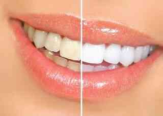 whitening treatments
